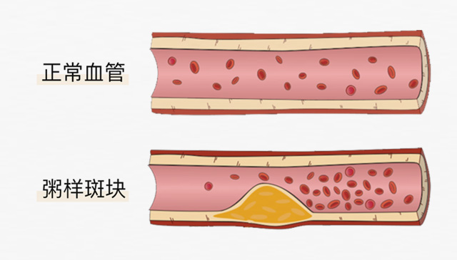 血栓是心梗、腦梗的元兇，很容易找上這些人