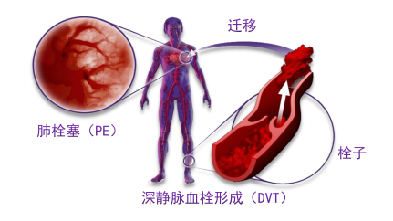 骨科術(shù)后重點(diǎn)關(guān)注的問題—VTE，該如何防治？