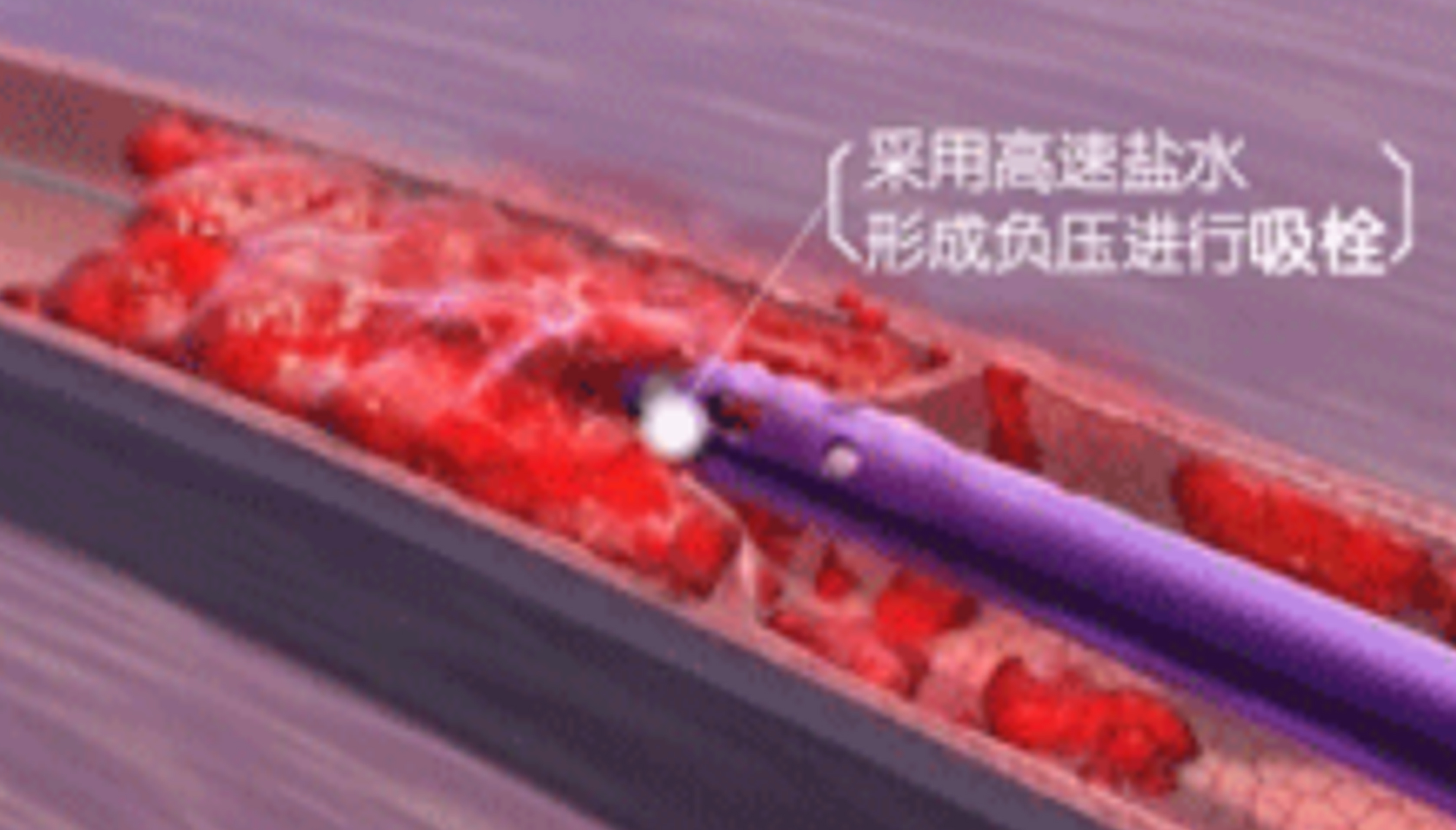 深靜脈血栓能致命，防治“大法”要了解！