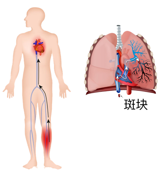 血栓是心梗、腦梗的元兇，很容易找上這些人