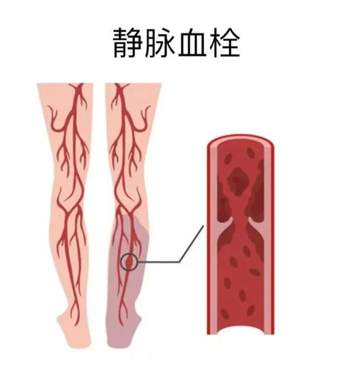 血栓是心梗、腦梗的元兇，很容易找上這些人