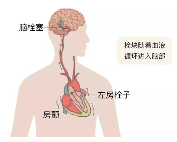 血栓是心梗、腦梗的元兇，很容易找上這些人