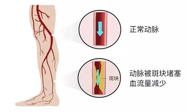 血栓是心梗、腦梗的元兇，很容易找上這些人