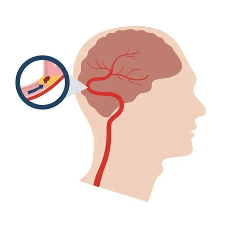血栓是心梗、腦梗的元兇，很容易找上這些人