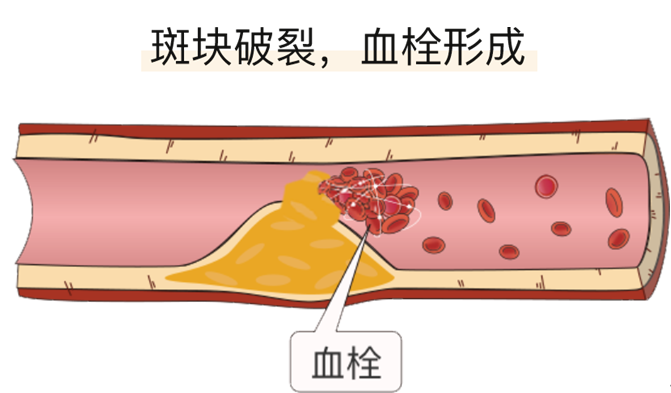 血栓是心梗、腦梗的元兇，很容易找上這些人