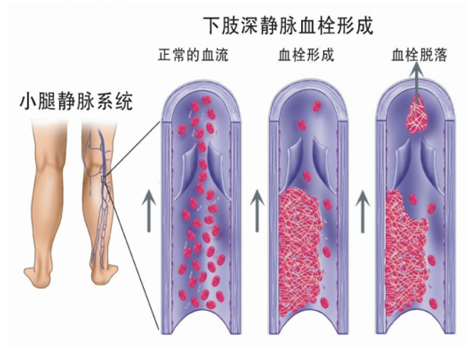 警惕！這個(gè)全球“第三大心血管殺手”，我們?cè)撊绾螒?yīng)對(duì)？