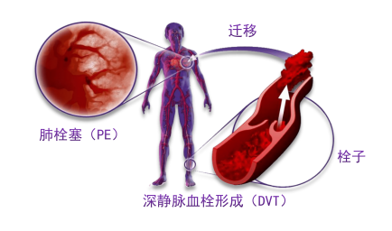 骨科術(shù)后重點(diǎn)關(guān)注的問題—VTE，該如何防治？
