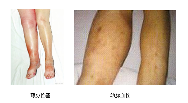 動(dòng)脈血栓和靜脈血栓有什么區(qū)別嗎？