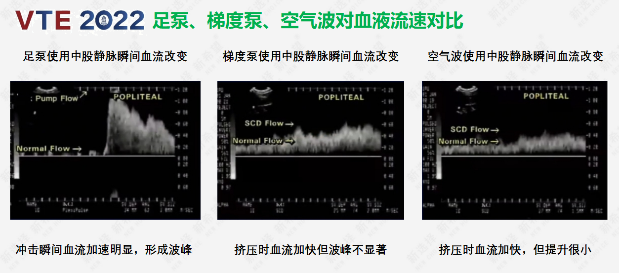 圍術(shù)期患者VTE的預(yù)防，只知道抗凝可不行