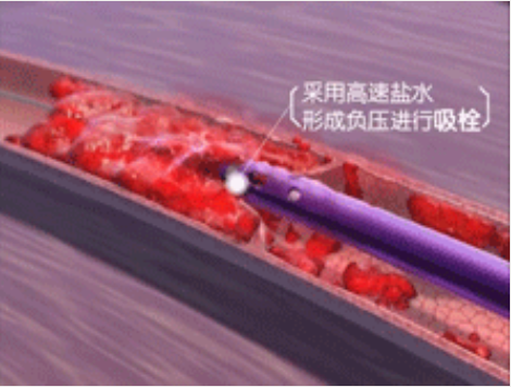 深靜脈血栓能致命，防治“大法”要了解！