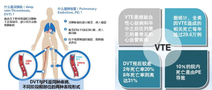 VTE的危害您了解嗎？