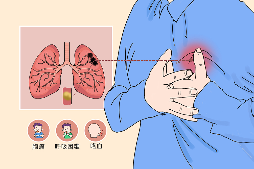 VTE的危害您了解嗎？
