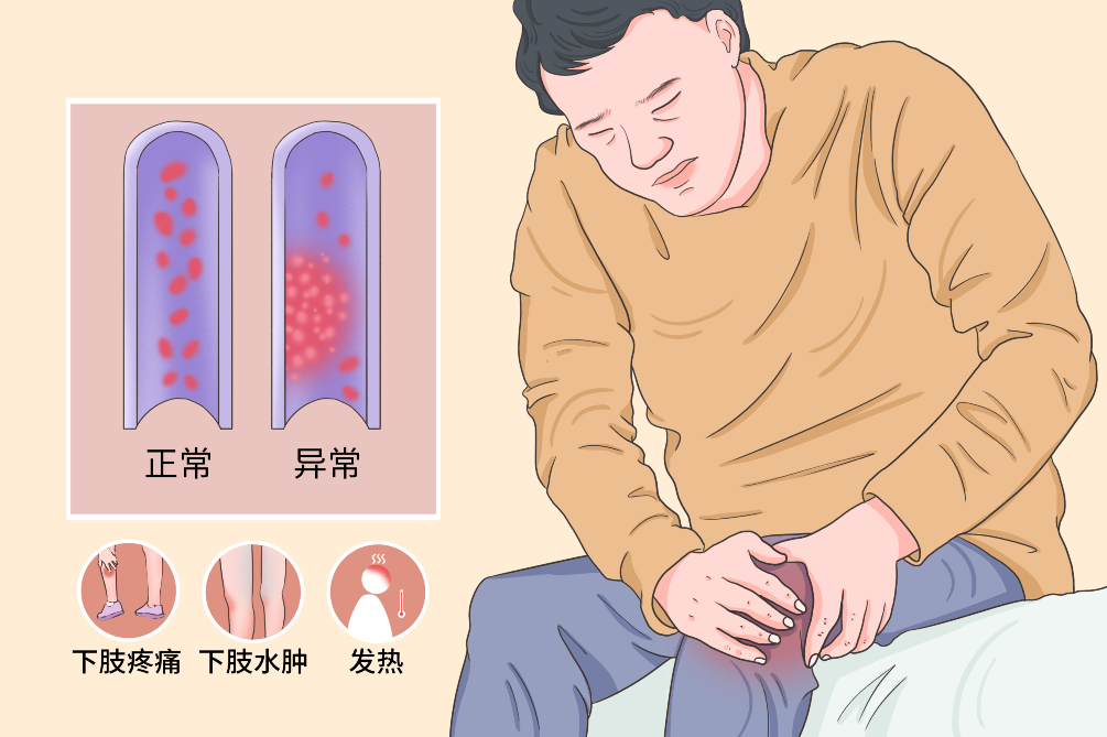 VTE的危害您了解嗎？