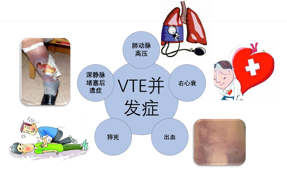 VTE的危害您了解嗎？